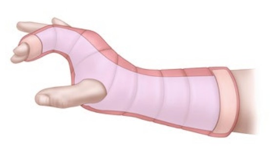 splint